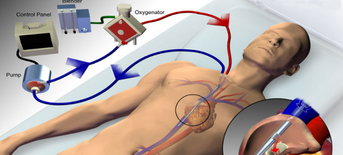 ECMO