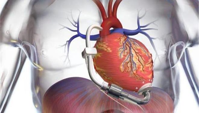 LVAD