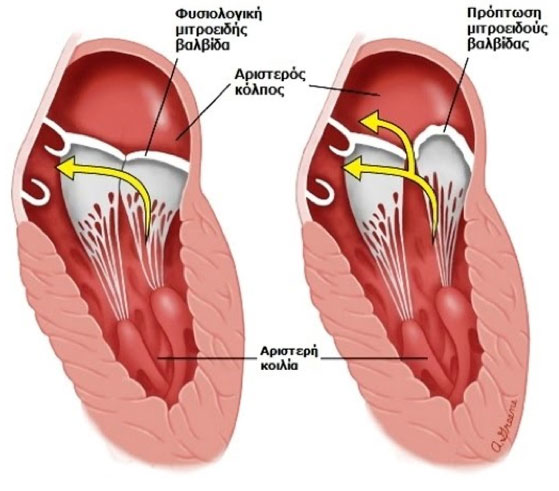 Proptosi mitroeidous
