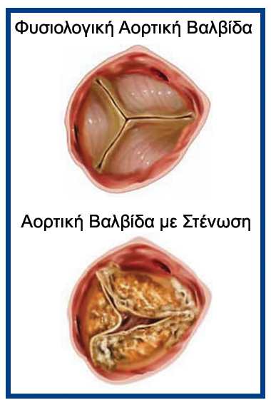 stenosi aortikis